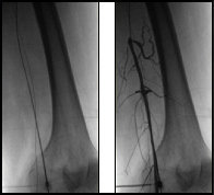 Unmet Need - Distal Access Medical Devices