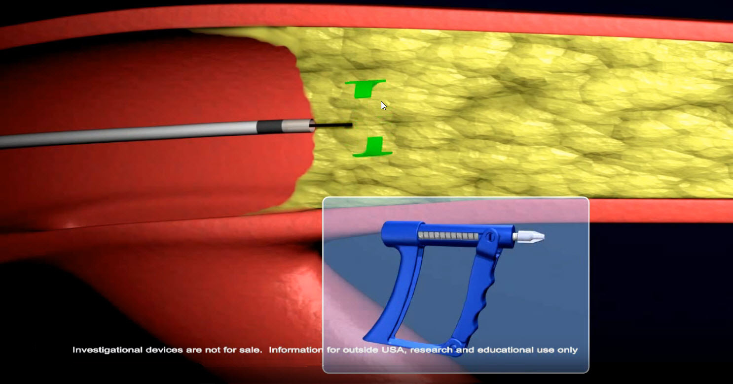 Distal Access - SPINR